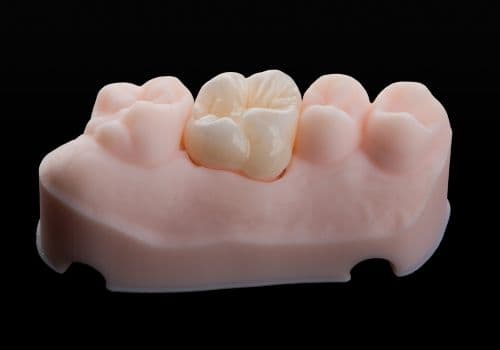 Model of a single dental crown after a root canal