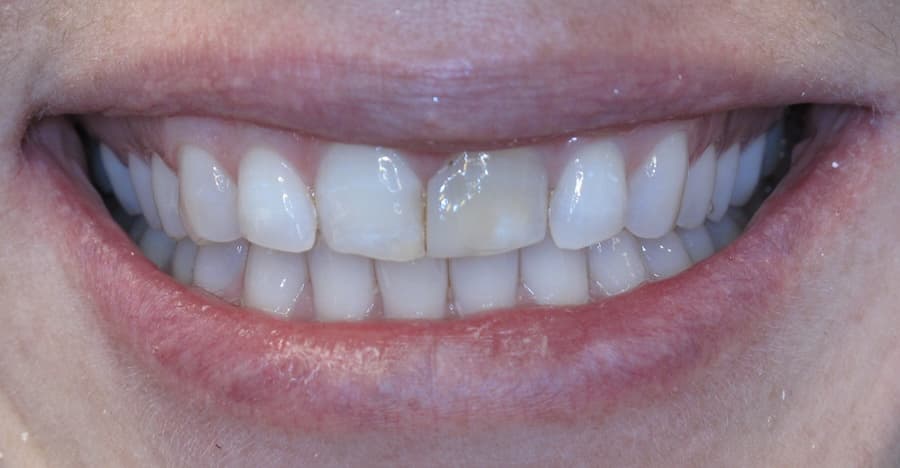 Crowns before
