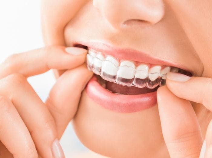 Read this if you're considering online clear aligners or other online dental products!