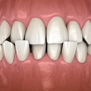 Illustration of a crossbite