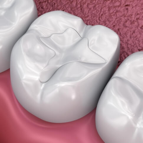 Animated smile with dental sealants