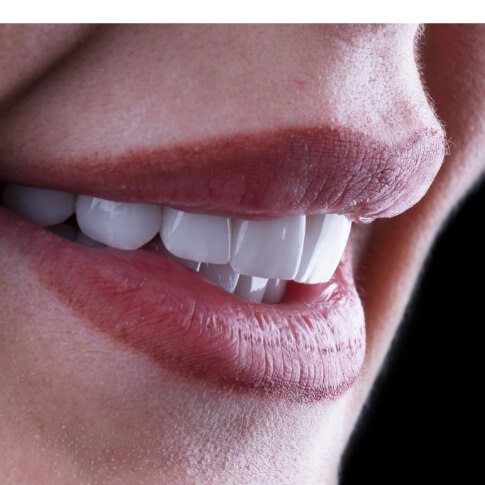 Closeup of smile with veneers