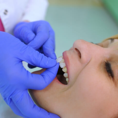 Dentist comparing smile to dental bonding color options