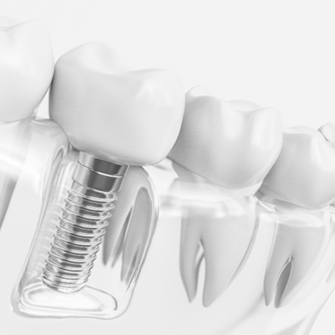 Ancloseup of dental implant model g