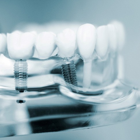 closeup of dental implant model 