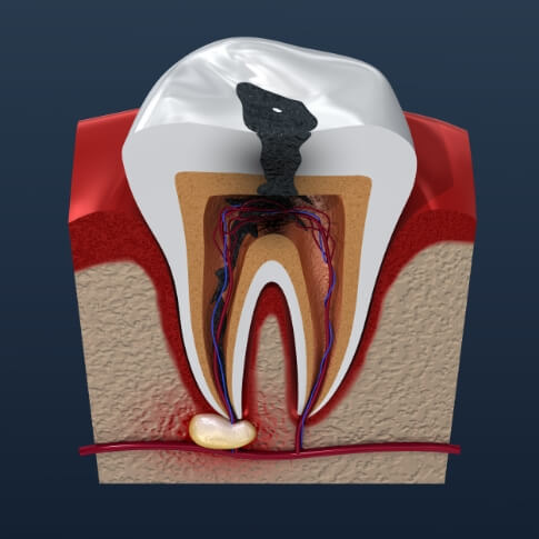 Animated inside of a tooth with pulp damage before root canal treatment