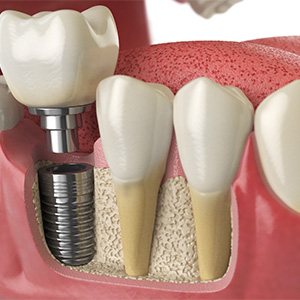 Illustrated dental crown being placed onto a dental implant in the lower jaw