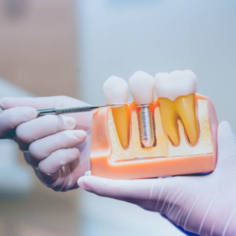 Model comparing dental implants to natural teeth