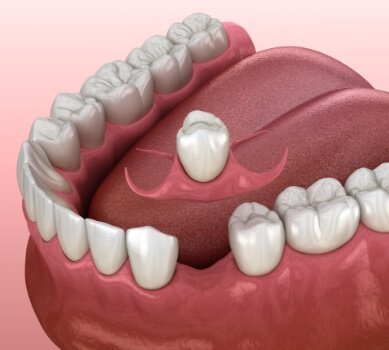 Animated smile during dental implant supported dental crown placement