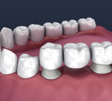 Animated smile during dental implant supported fixed bridge placement