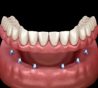 Animated smile during dental implant supported denture placement