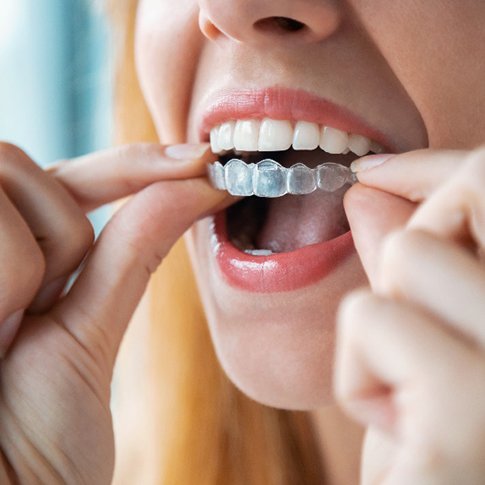 Closeup of patient placing her Candid aligners back in