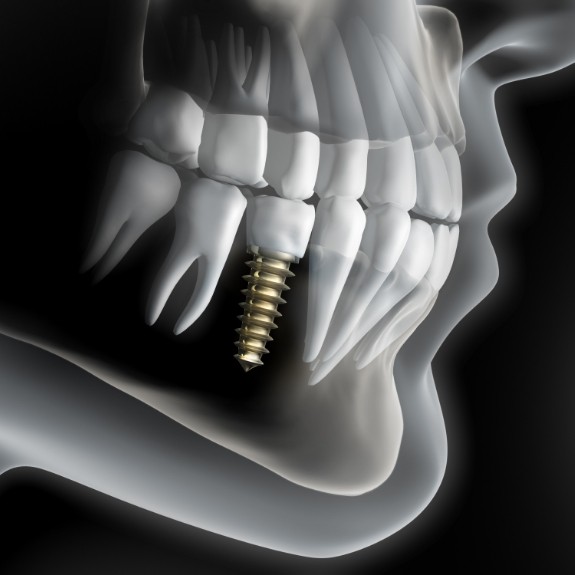 x ray of teeth