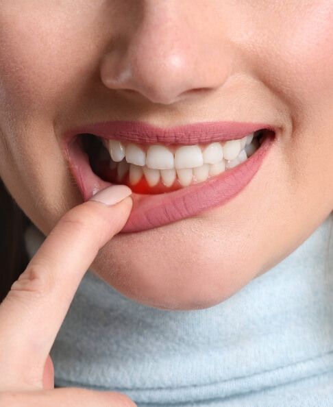 Closeup of smile with soft tissue damage before gum disease treatment