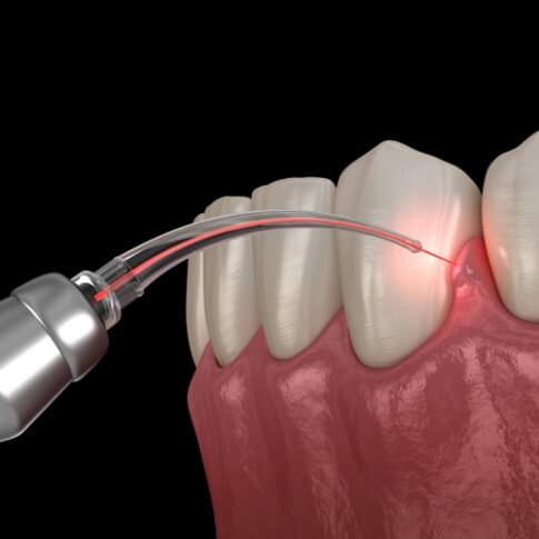 Animated smile during periodontal laser surgery
