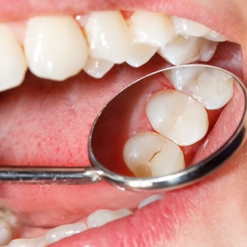 Dentist examining damaged smile before tooth colored fillings