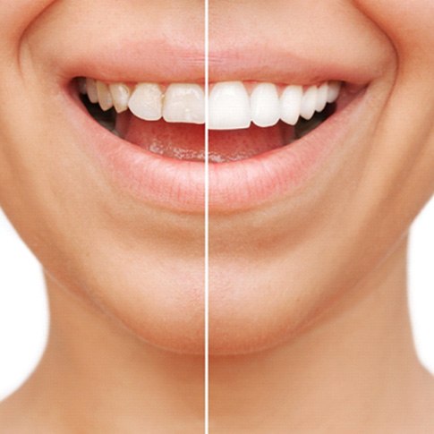 Closeup of patient's smile before and after veneers