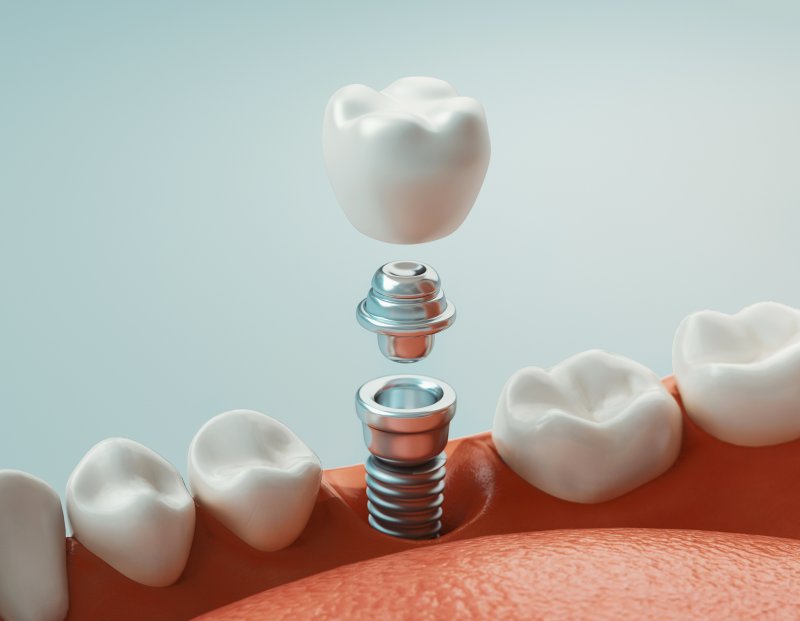 A 3D illustration of a dental implant