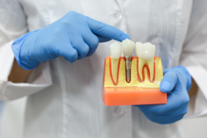 a closeup of a model of dental implants 