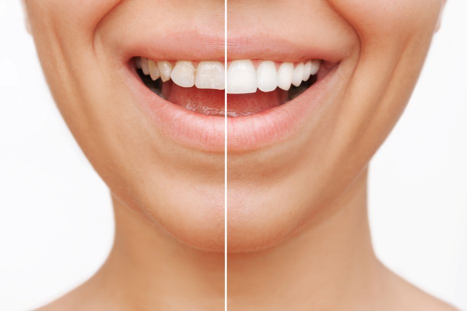 A woman with larger teeth after getting veneers