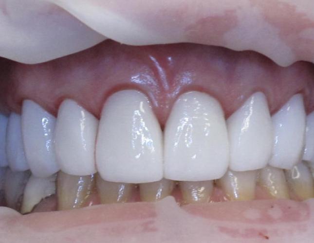 Case 1 After