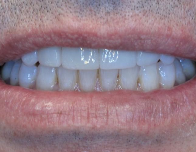 Case 1 After