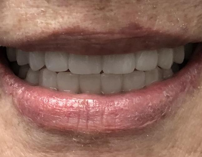 Dentures After
