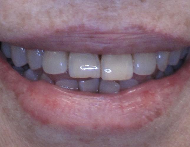Dentures Before