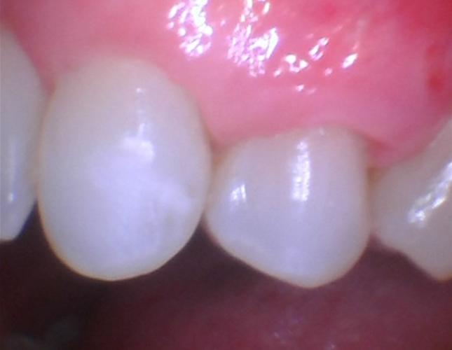 Gum Graft 1 After