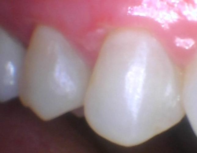 Gum Graft 2 After