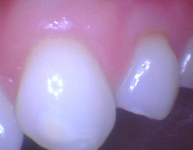 Gum Graft 3 After