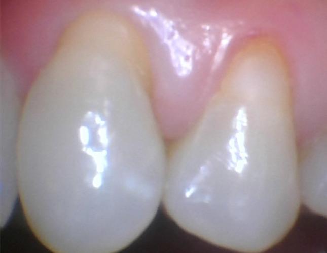 Gum Graft 1 Before