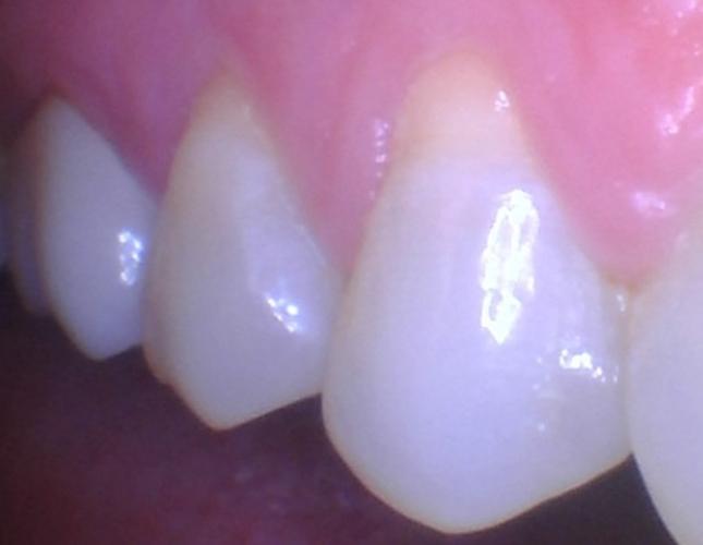 Gum Graft 2 Before