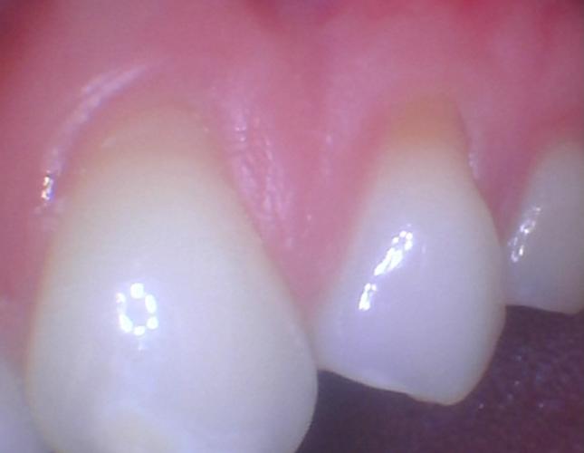 Gum Graft 3 Before