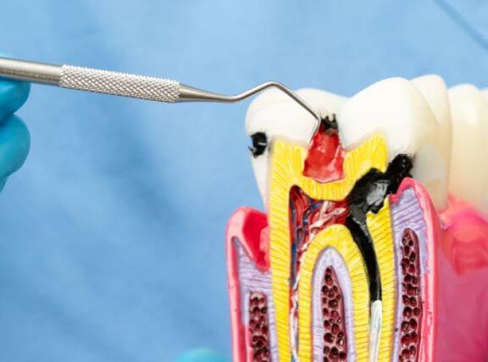 Root Canal Treatment FAQs: Common Patient Concerns and Clear Answers